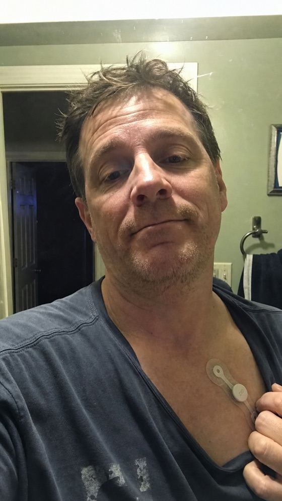 Patient wearing a Zio patch heart monitor